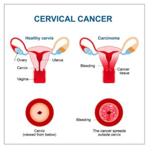 SH-Cervical cancer 1